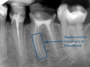 Abgebrochenes Instrument im Wurzelkanal | Quelle: Zahnarztpraxis Dr. Ludwig und Kollegen