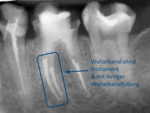 Wurzelkanal ohne Instrument | Quelle: Zahnarztpraxis Dr. Ludwig und Kollegen