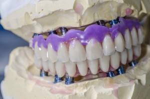 Neue Zähne an einem Tag – auf nur vier Zahnimplantaten | Quelle: shutterstock_sunlight19