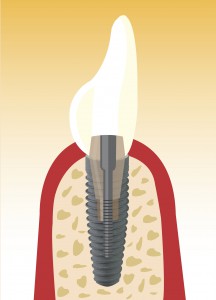 Schnelle Zahnimplantat Einheilung mit Eigenblutplasma | Quelle: Initiative proDente e.V.