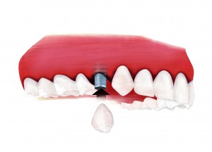 Die optimale Zahnimplantat-Heilung | © Initiative proDente e.V.