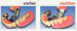 Quelle: microclean_schütz_dental|Zahnarztpraxis Dr. Ludwig und Kollegen_Prothesenreinigung