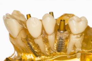 Zahnimplantate: Künstliche Zahnwurzeln | Zahnarzt Fürth; Quelle: Christoph Hähnel_fotolia.com